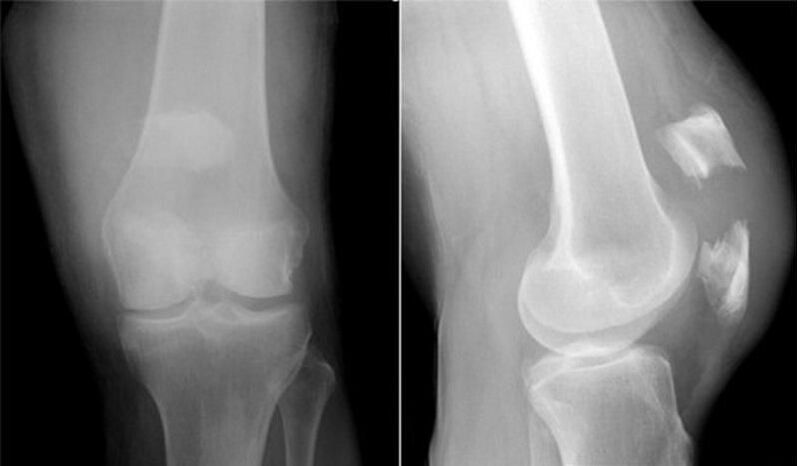 Deformáló térd osteoarthrosis 3 fokos kezelés